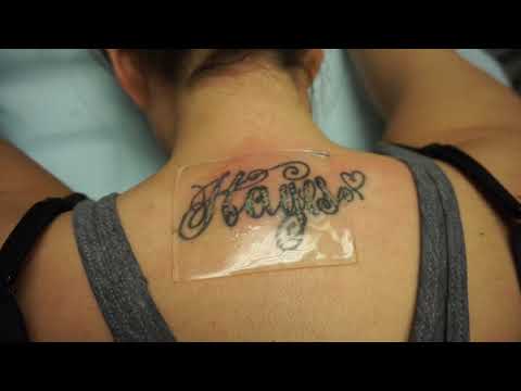 Squid (PFD) Patch Laser Tattoo Removal at South Coast MedSpa