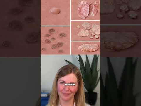 Was sind eigentlich Feigwarzen? #shorts