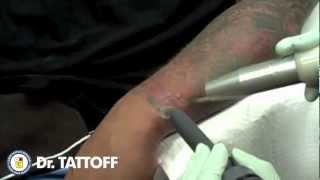 preview picture of video 'Laser Tattoo Removal - Half Sleeve Tattoo Removal Before and After  - Santa Ana, Orange County'