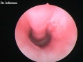 CYSTOSCOPY Post Op Septum Vagina Dog