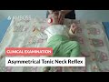 Asymmetrical Tonic Neck Reflex - Clinical Examination