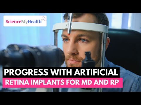 Progress with Artificial Retina Implants in Patients with Macular Degeneration