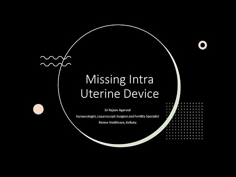 Removal of Missing Intra Uterine Device or IUD via Hysteroscope