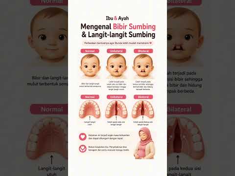 Mengenal Bibir Sumbing dan Langit-Langit Sumbing Bukan Kesalahan Ibu dan Bisa Ditangani #ibudanayah