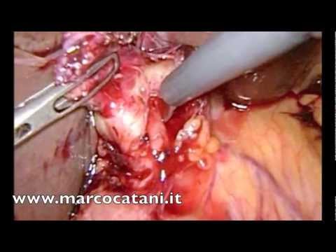 Sono incinto a me helminths Targhe da vermi di pinworms per la persona