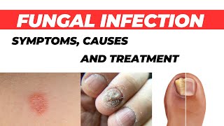 Fungal Infection: Symptoms, Causes, and Treatment | How to Cure Fungal Infection
