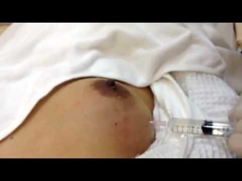 ผมไม่รู้สึกว่าหน้าอกหลังจาก mammoplasty วิธีการขยายขนาดหน้าอก 14 ปี