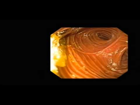 Jejunum, Abnormal Post Surgical Anatomy, Alementary Limb Fistula to Jj Anastomotis after Rygbp