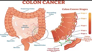 Colorectal cancer Surgery #ColorectalSurgery #BowelHealth