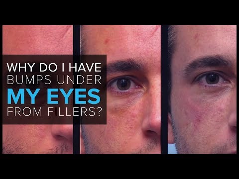 FAQ: “Why do I have bumps under my eyes after receiving fillers?”