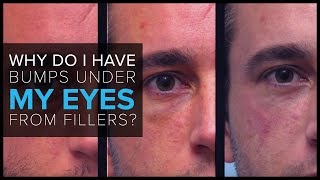 FAQ: “Why do I have bumps under my eyes after receiving fillers”