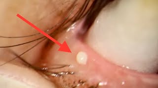 Popping Stye with Maskin Probe and Squeezing out Pus