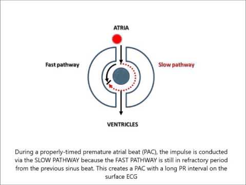 AV Nodal Reentry Tachycardia (AVNRT) for non-cardiologist in less than 2 minutes