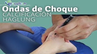 ONDAS DE CHOQUE - TRATAMIENTO CALCIFICACIÓN y TENDINITIS HAGLUNG Fisioterapia | Fisiolution
