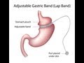 What Is Gastric Bypass or Weight Loss Surgery?