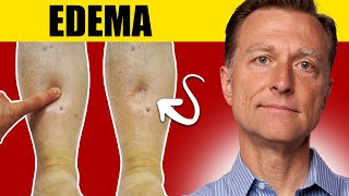 8 Surprising Causes of Edema: Uncover the Truth!