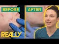Dr Emma Relieves Young Woman Of Severe Acne With Transformative Treatment The Bad Skin Clinic