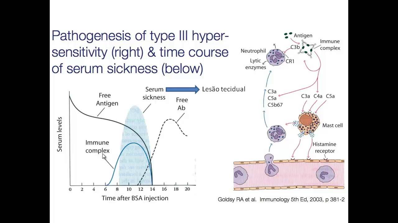 Hipersensibilidades (3/5): Tipo III - Mediado por imunocomplexos