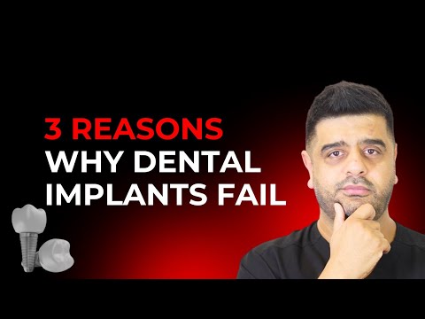 ⚠️ 3 Gründe, warum Zahnimplantate scheitern (und wie man es verhindern kann)