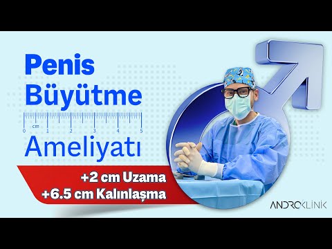 Penis Büyütme Ameliyatı (+2 cm uzama, +6.5 cm kalınlaşma) Op. Dr. Evren IŞIK