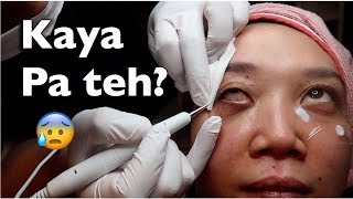 Syringoma Cauterization Treatment!