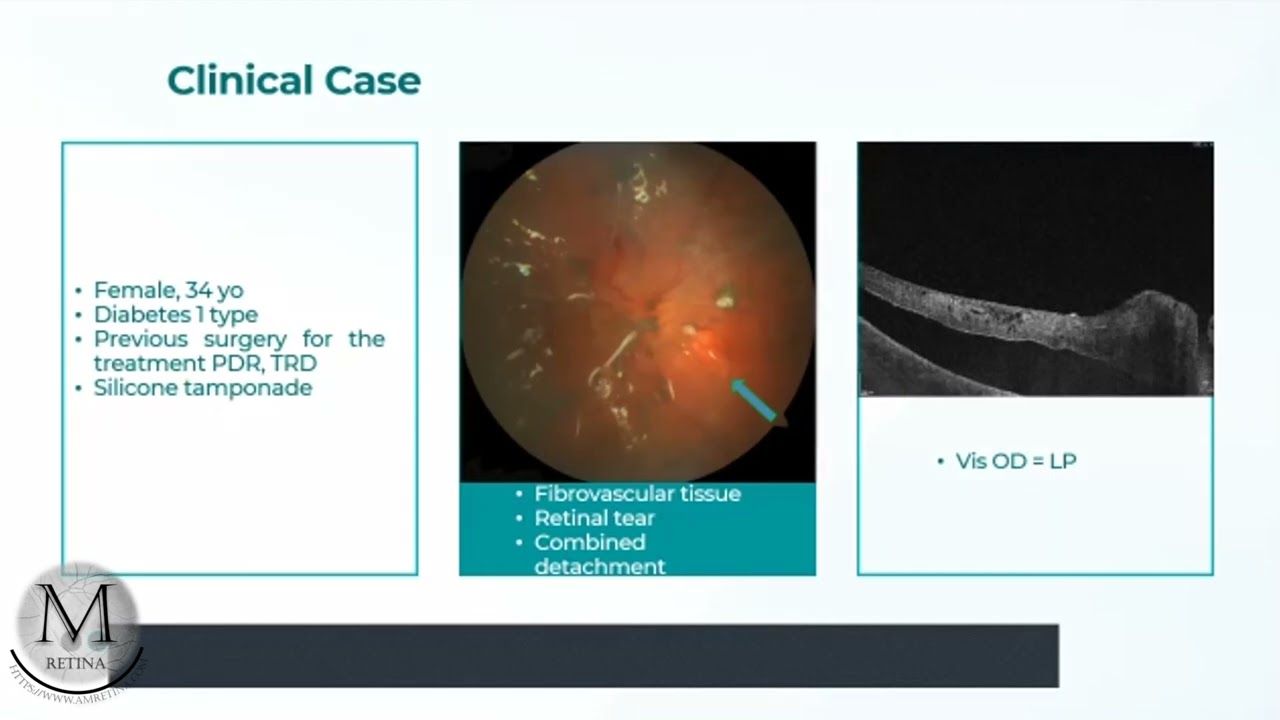Combined TRD and RRD Management