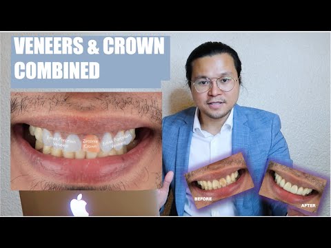 Veneers and Crown Combined | Wedding Ready Smile | Apostol Dental Philippines