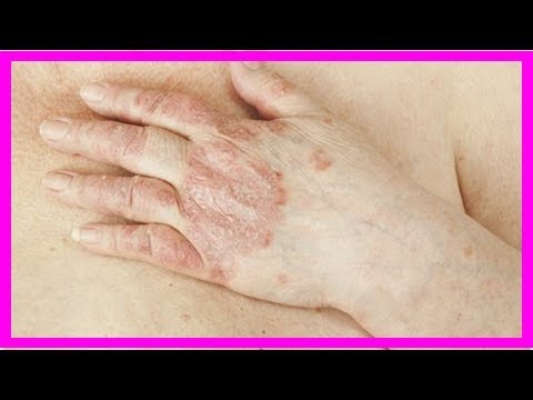 Die Creme skin kap bei atopitscheskom die Hautentzündung die Rezensionen Der Einstich von nejrodermita