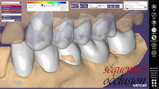 SEQUENTIAL OCCLUSION 2 / ПОСЛЕДОВАТЕЛЬНАЯ ОККЛЮЗИЯ 2 | EXOCAD