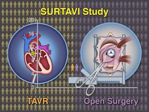 Transcatheter Aortic-Valve Replacement