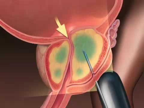 Prostata cisti prezzo chirurgia Prostata PSA nel sangue 6