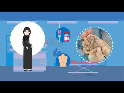 نموذج من الموشن جرافيك- الحملة الطبية للتخدير الآمن "أبرة الظهر"