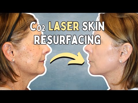 CO2 Laser Skin Resurfacing Treatment | Real OR Footage + Before & After Results ✨