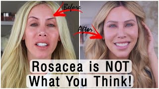 3 At-Home Steps to CURE Your Rosacea for GOOD! No Doctor Needed!