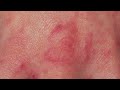 DO YOU HAVE SCABIES? CLOSE LOOK AT THE SCABIES RASH