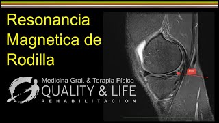 Resonancia Magnética Rodilla - Breve Explicación