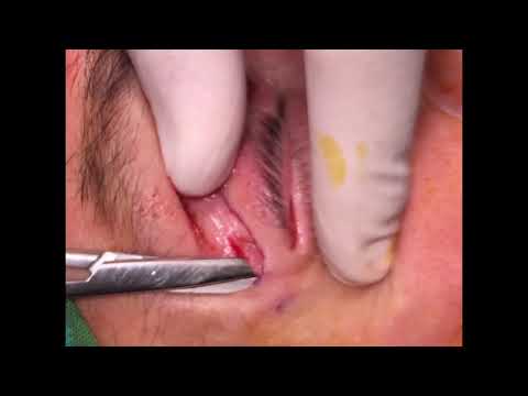 Plicatura cantal lateral