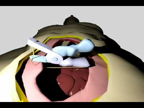 QuickStitch- Surgical Suturing Device to Improve Fascia Closure