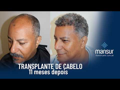 Miniatura do depoimento: Antes e depois de transplante capilar após 11 meses
