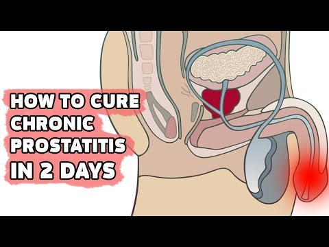 Prostatitis Einnahme von Antibiotika Stufe 3 Prostata-Hyperplasie