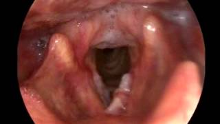 preview picture of video 'Stroboscopy in Carcinoma Vocal Cords. Dr.Meenesh Juvekar (Bombay Hospital- Mumbai)'