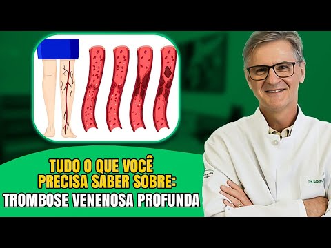 O Que é Trombose Venosa Profunda?  Dr. Robert Wagner Explica!