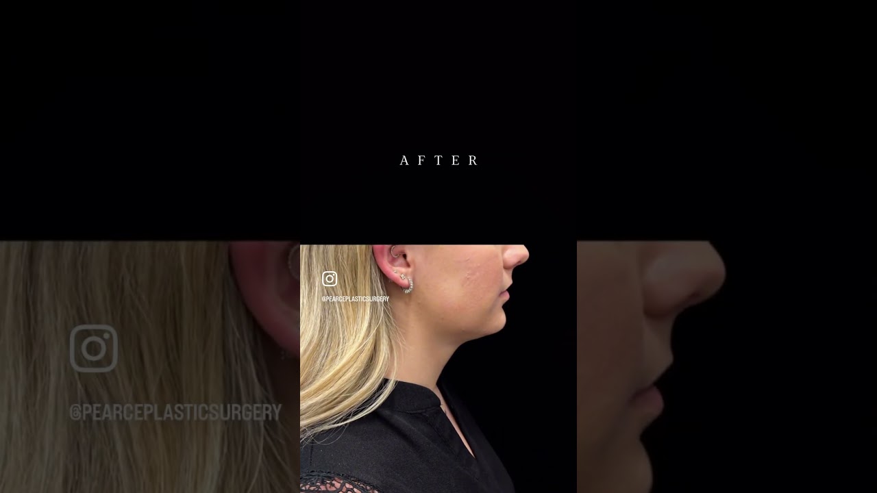 Impressive Chin Lipo Results || Austin Chin Lipo