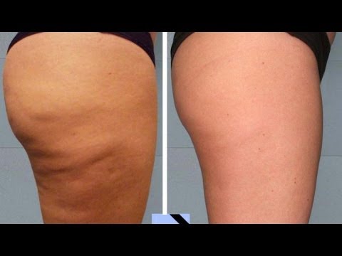 Como puedo adelgazar las piernas yahoo