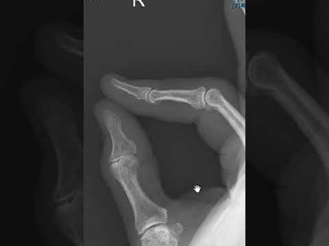 Central slip tear index finger