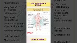 Download lagu Down Syndrome | Trisomy 21 | Genetic Disorder in Human mp3