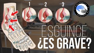 🦶🏻 Como saber si un ESGUINCE de tobillo es GRAVE