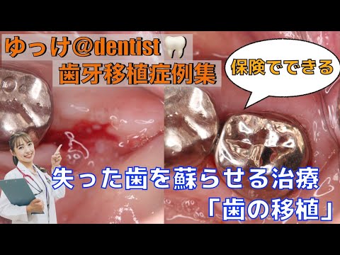 生命歯学科 【歯牙移植症例集】埋伏歯を使った歯牙移植🦷奥歯を失ってもインプラントだけじゃない‼️保険治療でここまでできる？抜歯宣告されたとき歯を残すことができる歯の移植🦷「抜歯後待機歯牙移植」を大公開❗️