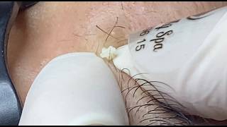 Blackhead & Whitehead Extractions #HoangMySpa202