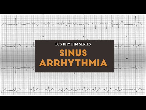 Sinus Arrhythmia | ECG Rhythm Series